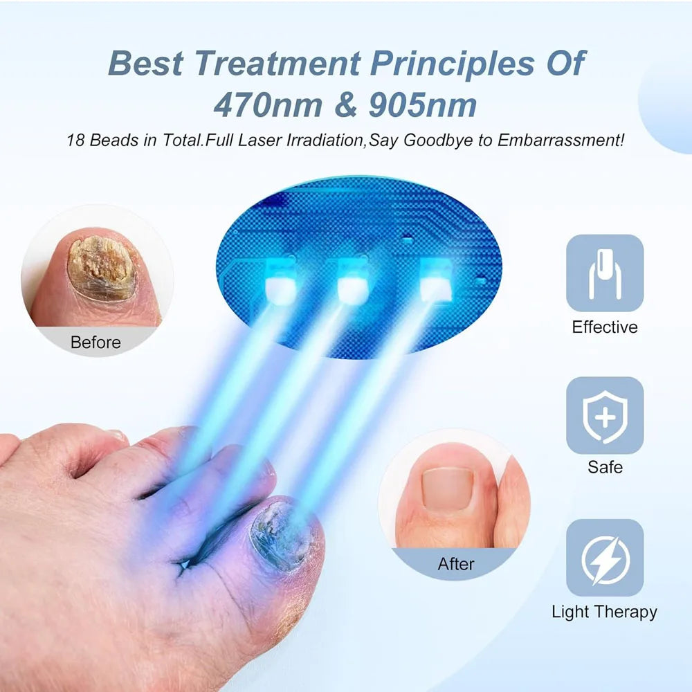 Fungal Nail Laser Device